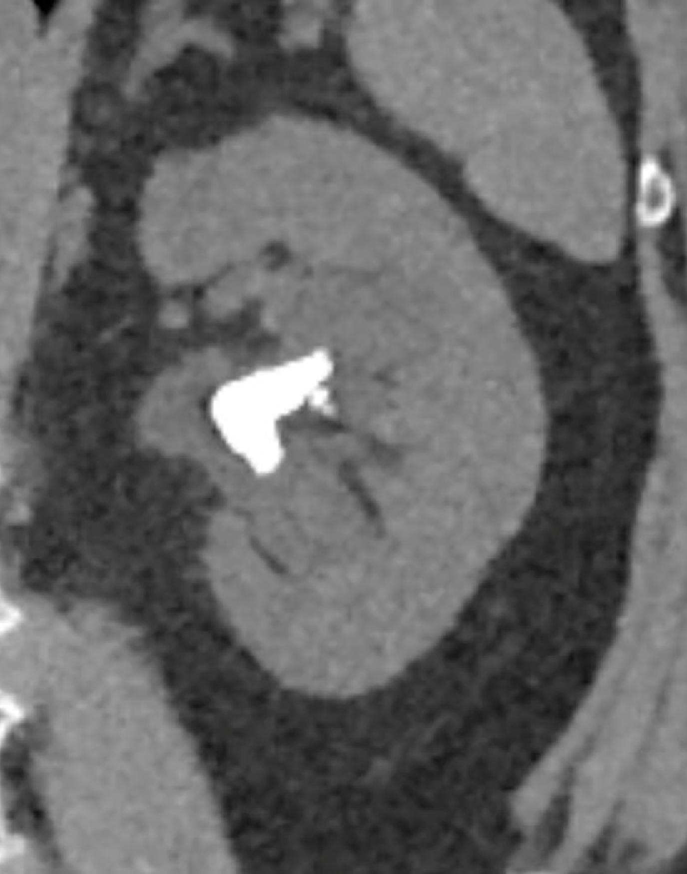 Fig. 6.3, Staghorn calculus in the kidney pelvis on a noncontrast CT.