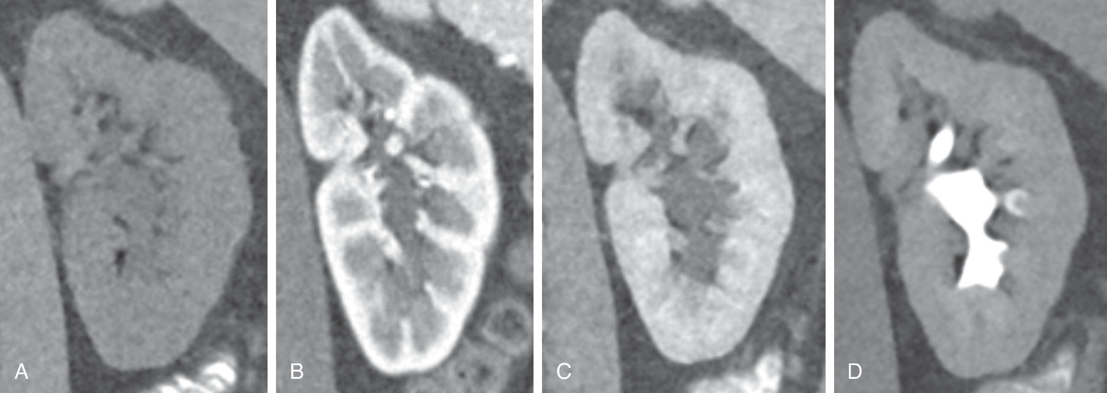 Fig. 6.4, A normal kidney imaged with CT in four different phases of contrast (A-D, left to right): noncontrast, corticomedullary phase, nephrographic phase, and excretory phase.