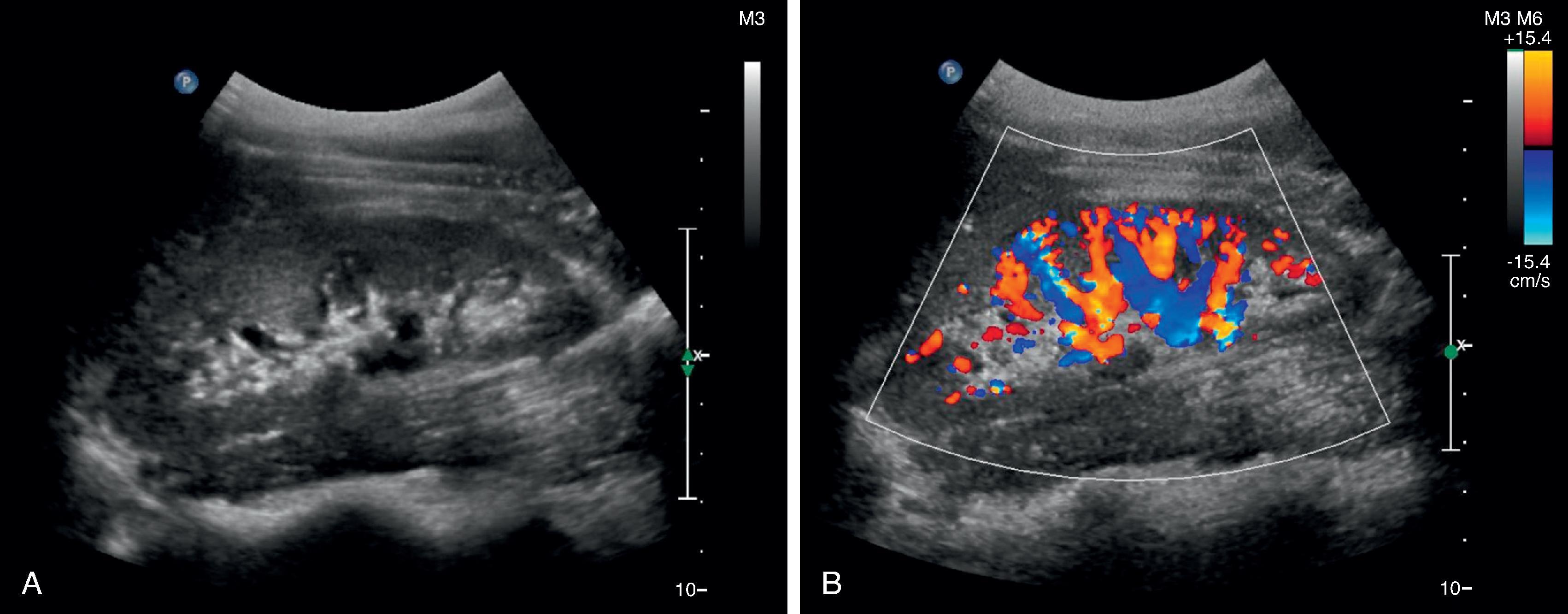 Fig. 6.5, A normal kidney imaged with ultrasound.