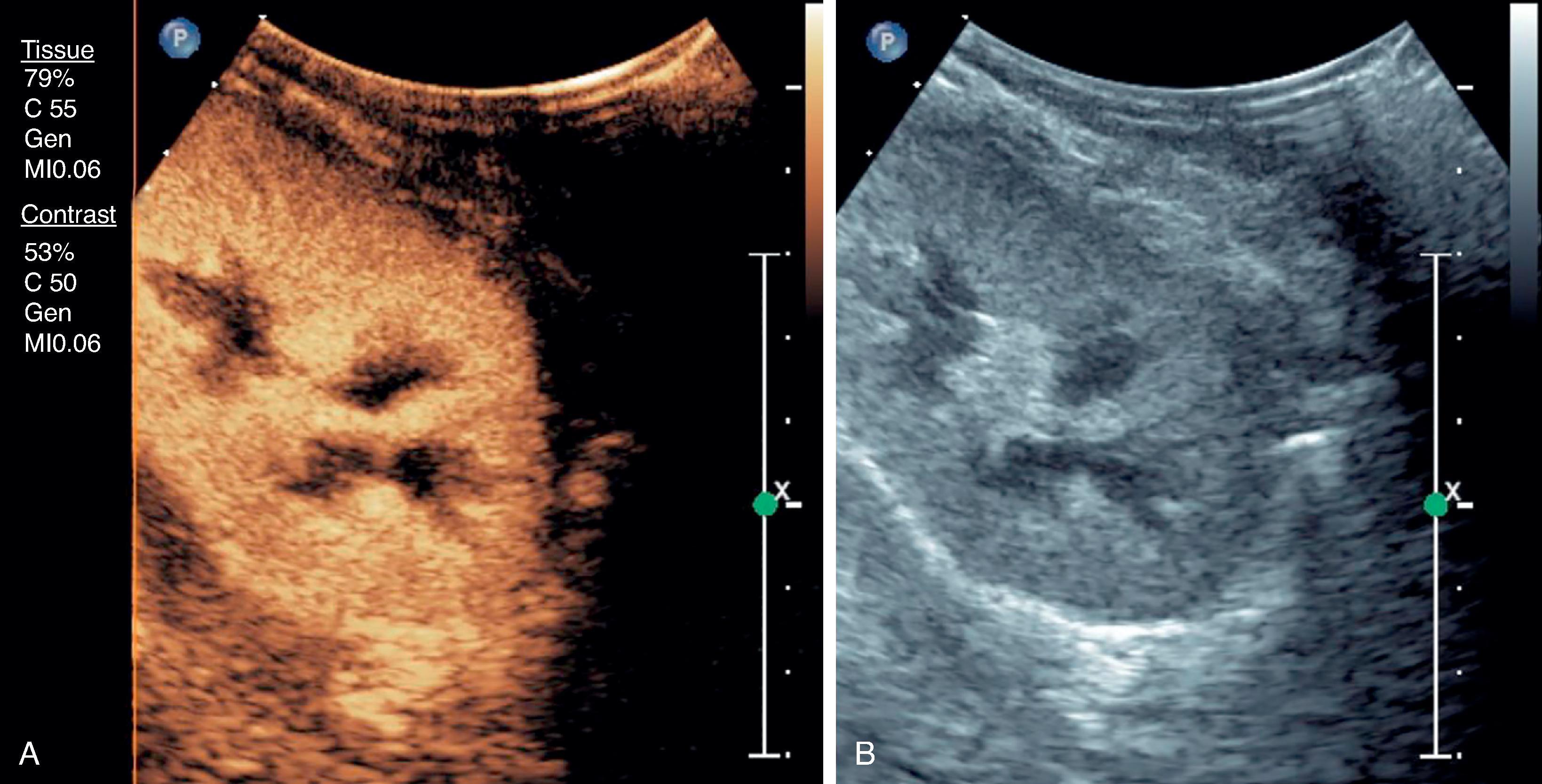 Fig. 6.6, A contrast-enhanced image of a normal kidney transplant.