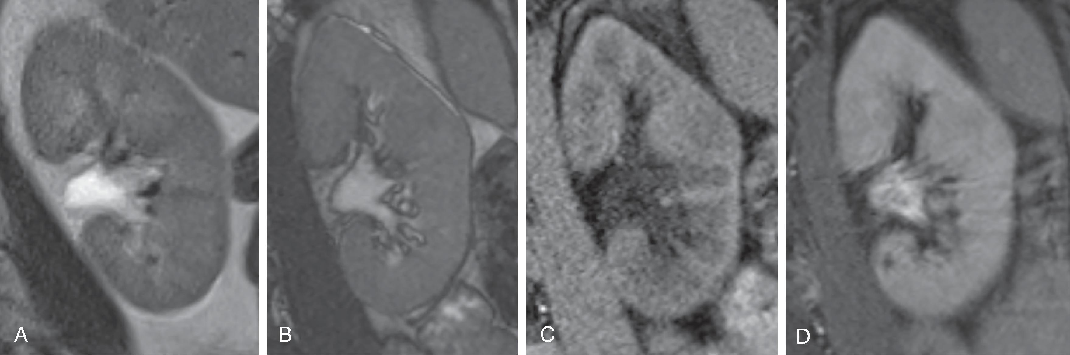 Fig. 6.7, Four coronal images of the same normal kidney with different MRI sequences (A-D, left to right): T2-weighted sequence, balanced steady-state free procession sequence, T1-weighted sequence, postcontrast T1-weighted sequence.