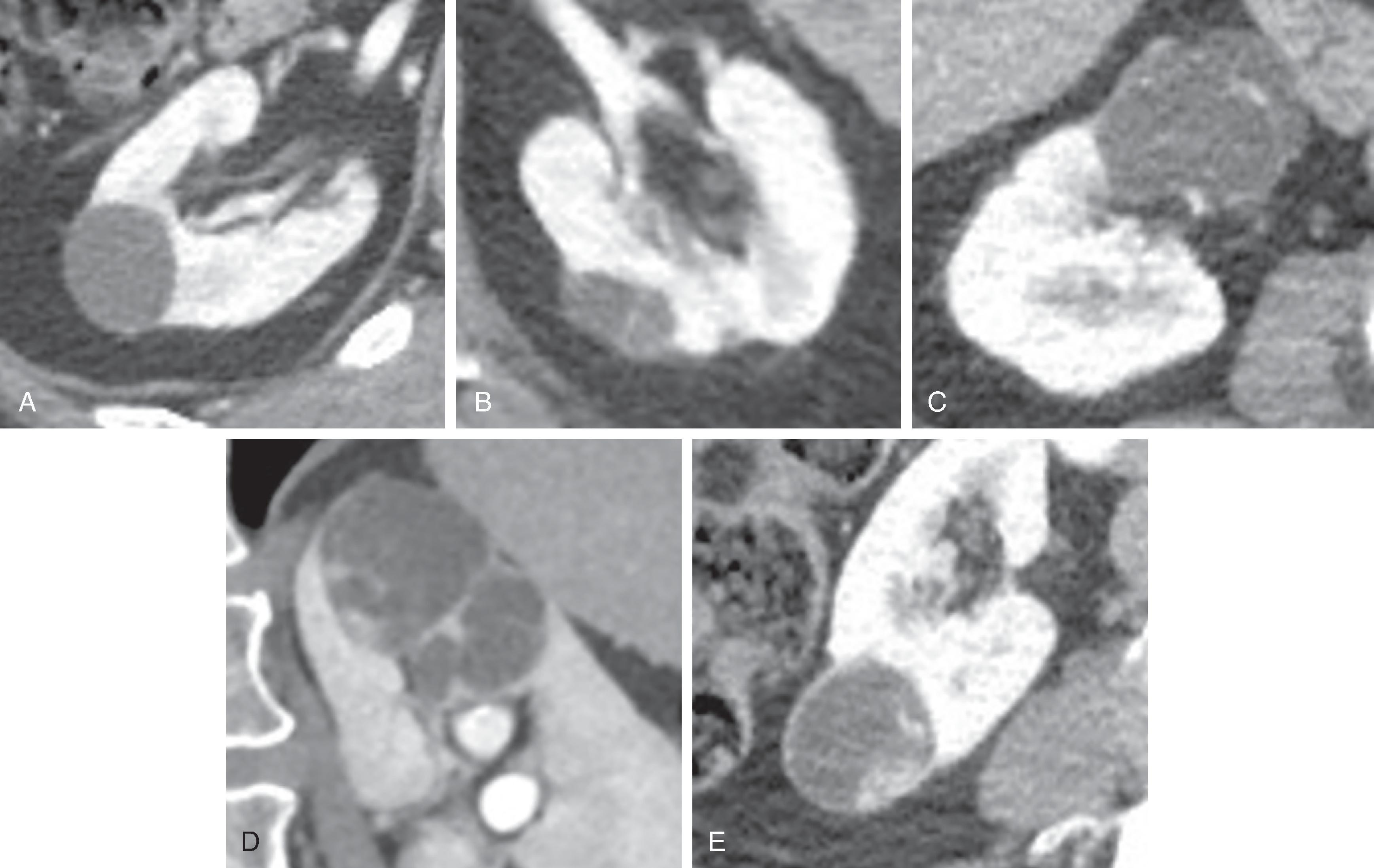 Fig. 6.9, Images of kidney cysts with varying degrees of complexity.