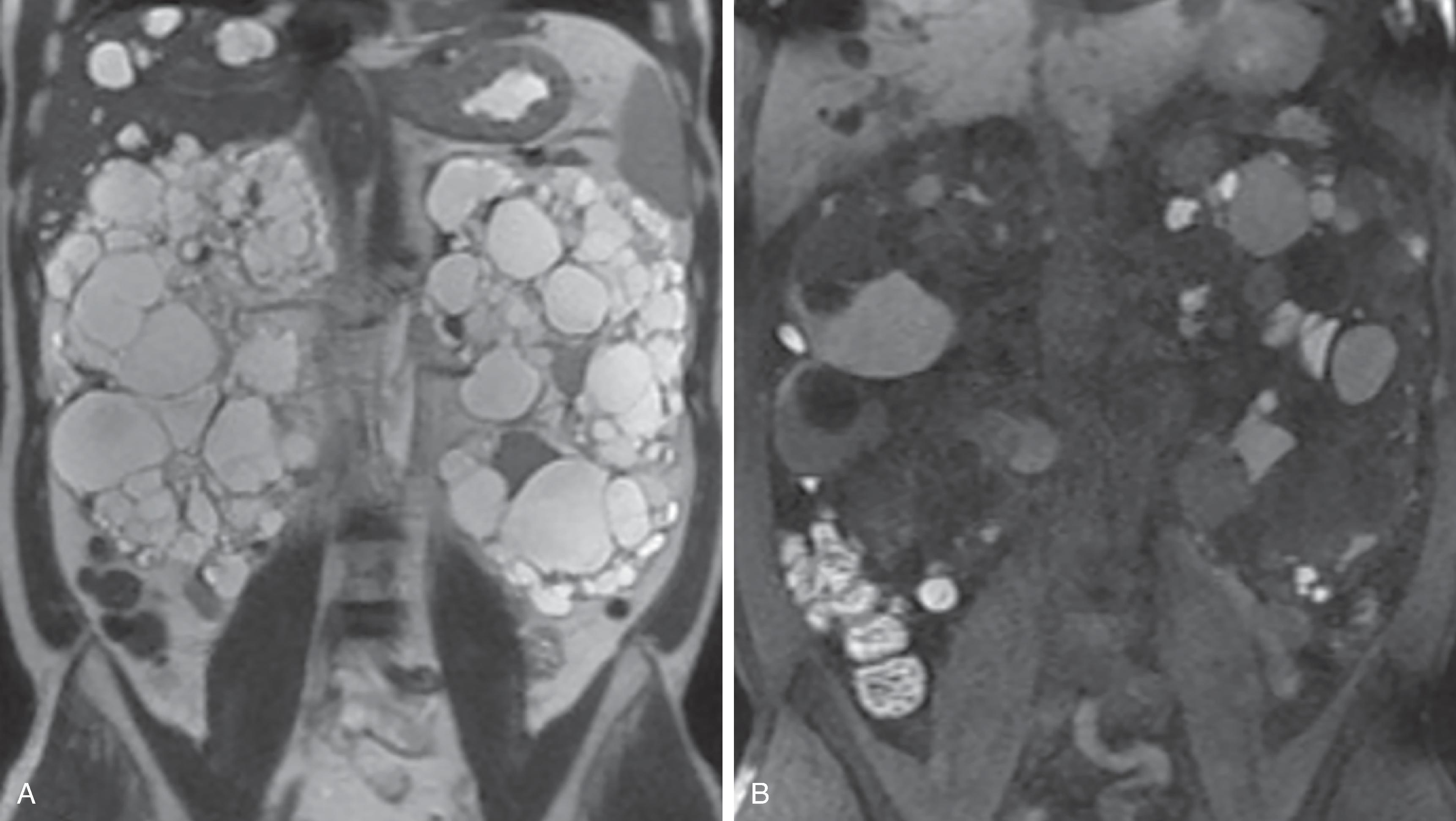 Fig. 6.10, Autosomal dominant polycystic kidney disease.