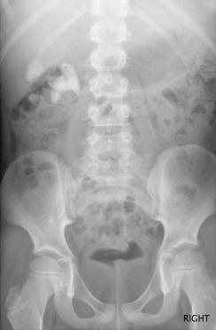 Fig. 72.1, Renal Calculus.