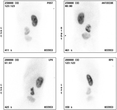 Fig. 72.16, Ectopic Kidney.