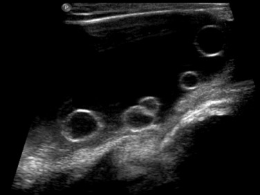 Fig. 72.5, Ovarian Cysts.