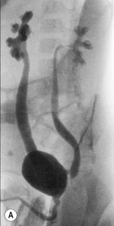 Fig. 72.9, Posterior Urethral Valves on Micturating Cystourethrography.