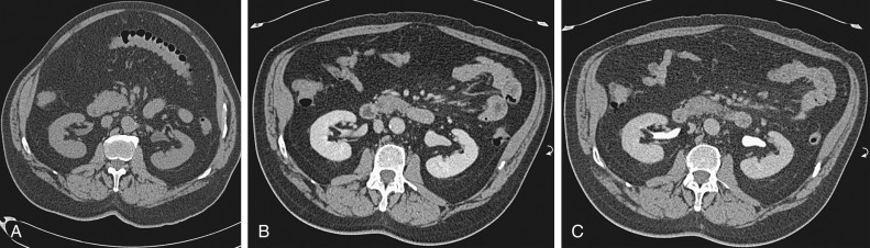 Figure 62-1, Normal computed tomography (CT) appearance of the kidneys. Unenhanced CT (A) shows uniform attenuation of the renal parenchyma in a background of renal sinus and perinephric fat. Contrast-enhanced CT images of the kidneys in nephrographic (B) and excretory or delayed-phase (C) images.