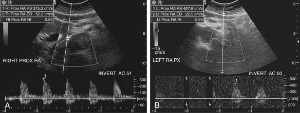 Figure 62-11, Bilateral renal artery stenosis in a patient with refractory hypertension and advanced atherosclerotic disease. Color Doppler imaging and spectral waveform analysis of both proximal renal arteries (RA) show elevated peak systolic velocities of 315.3 cm/s on the right and 457.8 cm/s on the left.