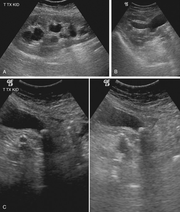 Figure 62-12, A 64-year-old patient presented with a right lower quadrant transplant. A and B, Sagittal and transverse ultrasound images show moderate hydronephrosis. C, Transverse ultrasound images show an obstructing stone in the right ureteropelvic junction.