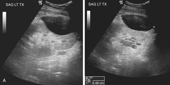 Figure 62-13, A 48-year-old patient presented with a left lower quadrant transplant. Sagittal ultrasound images show a nonspecific peritransplant fluid collection.