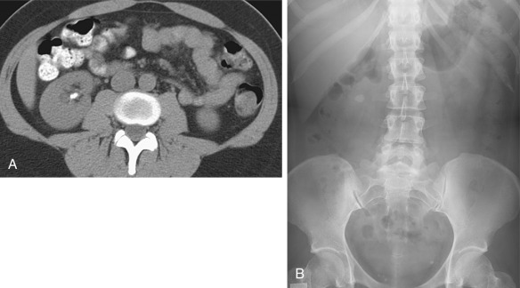 Figure 62-2, A 34-year-old woman presented with right-sided flank pain. A, Axial unenhanced computed tomography scan shows a nonobstructing right renal stone. B, Plain film radiograph also demonstrates the right renal stone and could be used for follow-up imaging.