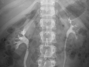 Figure 62-4, Radiographs obtained 5 minutes after compression. The collecting systems are now well distended.