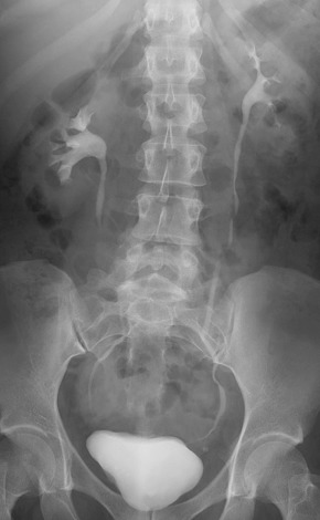 Figure 62-5, Radiograph obtained immediately after the release of compression as contrast agent fills the ureters.