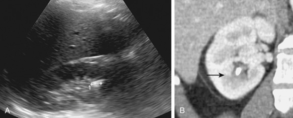 Figure 62-6, A 51-year-old woman presented with abdominal pain. A, Sagittal ultrasound image shows a nonobstructing stone (1) in the lower pole of the right kidney as an echogenic focus. Posterior acoustic shadowing was also present (not shown). B, Coronal computed tomography shows the stone (arrow).