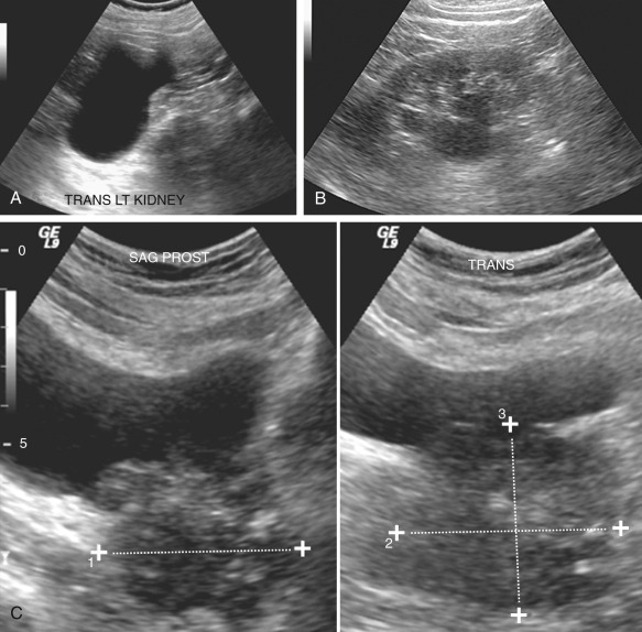 Figure 62-7, Metastatic prostate cancer in an 88-year-old man. Sagittal ultrasound images of the kidneys show (A) severe left and (B) mild right hydronephrosis. C, Sagittal and transverse images of the bladder show the enlarged prostate (measured with calipers) with mass effect on the bladder.