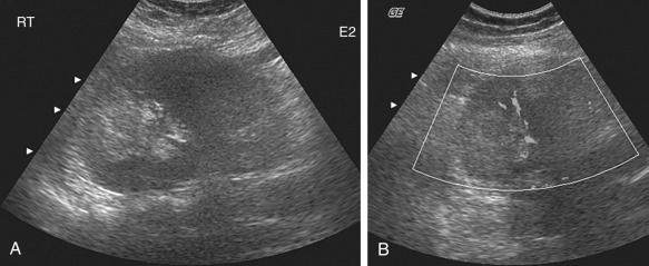 Figure 62-8, Pyelonephritis in a 23-year-old woman. Sagittal images of the right kidney show a focal hyperechoic region in the upper pole with decreased perfusion.