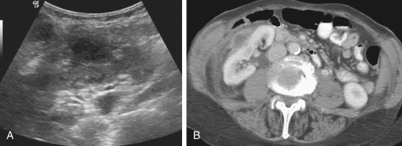 Figure 62-9, Perirenal abscess in an 87-year-old woman. A, Sagittal ultrasound image of the right kidney shows a hypoechoic perirenal mass with posterior acoustic enhancement and internal debris. B, Axial contrast-enhanced computed tomography confirms the right perirenal abscess.