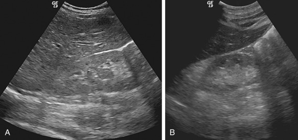 Figure 62-10, Sagittal ultrasound images in (A) a 39-year-old woman with chronic renal insufficiency of unclear cause and (B) a 56-year-old woman with diabetic nephropathy. Both images show increased renal cortical echogenicity greater than the liver, consistent with medical renal disease.