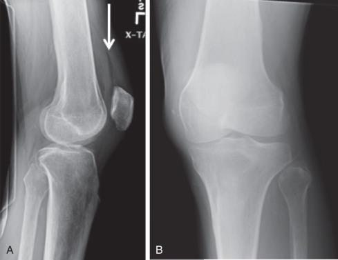 Fig. 91.1, Lateral radiograph (A) demonstrates the straight line between the layering radiolucent fatty component and the more radiodense fluid/cellular component of a knee joint lipohemarthrosis (white arrow) . Oblique frontal radiograph (B) fails to show the fracture.