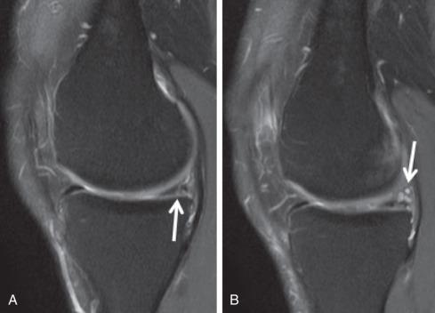 Fig. 91.11, Sequential sagittal proton density fat saturation (A and B) images demonstrate a posterior horn medial meniscal tear ( arrow in A) communicating with a parameniscal cyst ( arrow in B).