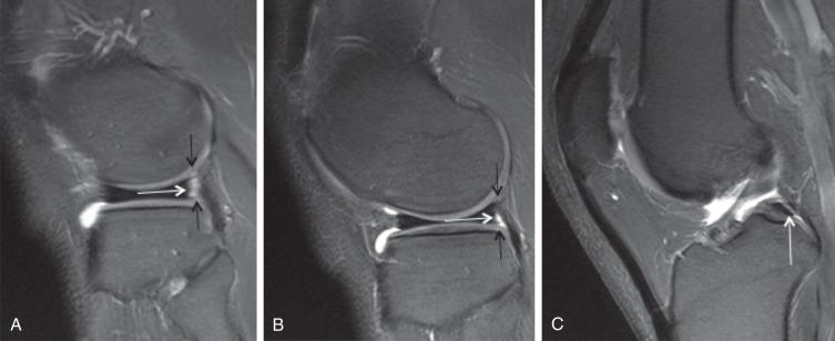 Fig. 91.12, Sequential sagittal proton density fat saturation images lateral to medial (A–C) demonstrate the normal increased signal posterior to the posterior horn lateral meniscus ( white arrow in A and B), bordered superiorly and inferiorly by the meniscopopliteal fascicles ( black arrows in A and B). The medial-most image (C) demonstrates the takeoff of the meniscofemoral ligament of Humphrey (arrow) . Incidental note is made of a discoid configuration to the lateral meniscus, a relatively common variant.