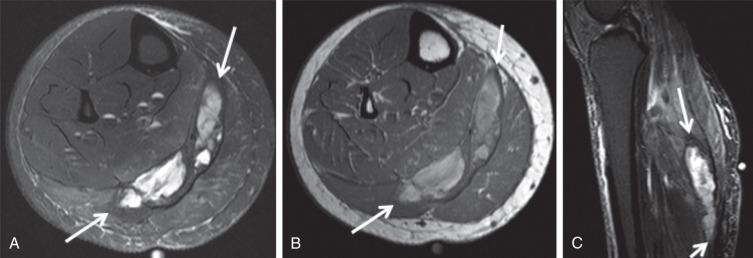 Fig. 91.13, Axial T2 fat saturation (A), T1 (B) images demonstrate heterogeneous hematoma/edema in the expected region of the plantaris (arrows) . Sagittal short-tau inversion recovery image (C) demonstrates tracking of the collection craniocaudally (arrows) .