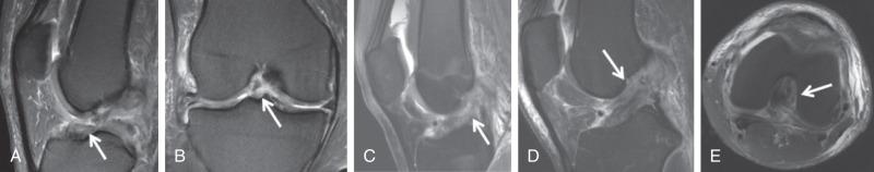 Fig. 91.14, Sagittal (A), coronal proton density fat saturation (PD FS) (B) images demonstrate a complete anterior cruciate ligament (ACL) tear at the tibial attachment (arrows) . Sagittal PD FS image (C) in a second patient demonstrates a midsubstance ACL tear. Sagittal (D), axial T2 FS (E) images in a third patient demonstrate ACL tear from the femoral attachment (arrows) .