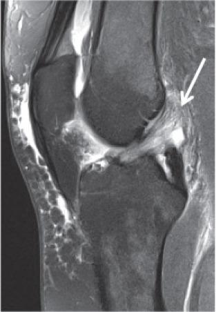 Fig. 91.15, SAG PD FS image demonstrates mucoid degeneration of the anterior cruciate ligament (arrow) .