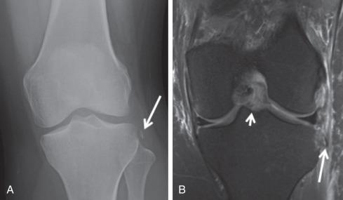 Fig. 91.16, Frontal radiograph (A) demonstrates a curvilinear fragment of mineralization adjacent to the lateral tibial plateau consistent with a Segond fracture (arrow) . Coronal proton density fat saturation image (B) demonstrates the Segond fracture (long arrow) with edema in the fracture and host bone. The anterior cruciate ligament tear is partially visualized (short arrow) .