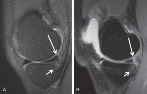 Fig. 91.17, Sagittal proton density fat saturation (PD FS) image (A) demonstrates meniscocapsular contusion without separation (long arrow) . Medial tibial plateau edema also presents (short arrow) . Sagittal PD FS image in a different patient (B) shows meniscocapsular separation (long arrow) with medial tibial plateau edema (short arrow) . Both cases had complete anterior cruciate ligament tears (not shown).