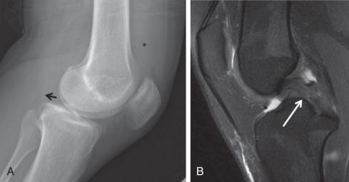 Fig. 91.18, Lateral radiograph (A) shows posterior translation of the tibia with respect to the femur (arrow) and moderate joint effusion (asterisk) . Corresponding sagittal proton density fat saturation image (B) shows complete posterior cruciate ligament tear (arrow) .