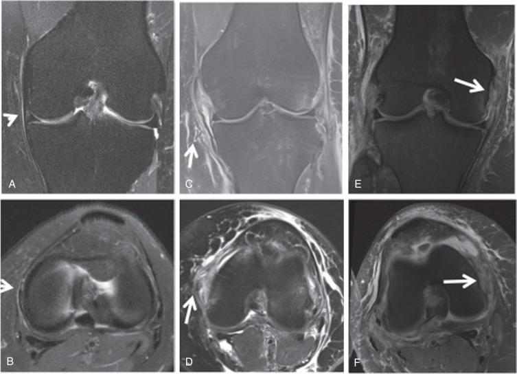 Fig. 91.19, Coronal (A) and axial proton density fat saturation (PD FS) (B) images demonstrate increased fluid signal superficial and deep to the medial collateral ligament (MCL) (arrows) , consistent with grade I injury. Coronal (C) and axial PD FS (D) images in a second patient demonstrate partial disruption of the MCL fibers (arrows) , consistent with grade II injury. Coronal (E) and axial PD FS (F) images in a third patient show complete MCL disruption (arrows) , consistent with grade III injury.