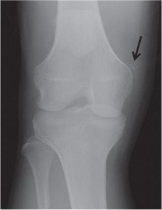 Fig. 91.20, Frontal radiograph demonstrates heterogeneous ossification in the region of the medial collateral ligament origin (arrow) consistent with a Pelligrini-Steida lesion.