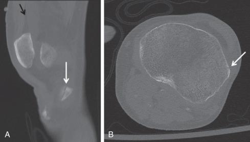 Fig. 91.2, Sagittal (A) and axial (B) computed tomography images of same patient as Fig. 91.1 show the nondisplaced lateral tibial plateau fracture (white arrows) . The lipohemarthrosis is again noted in A (black arrow) .