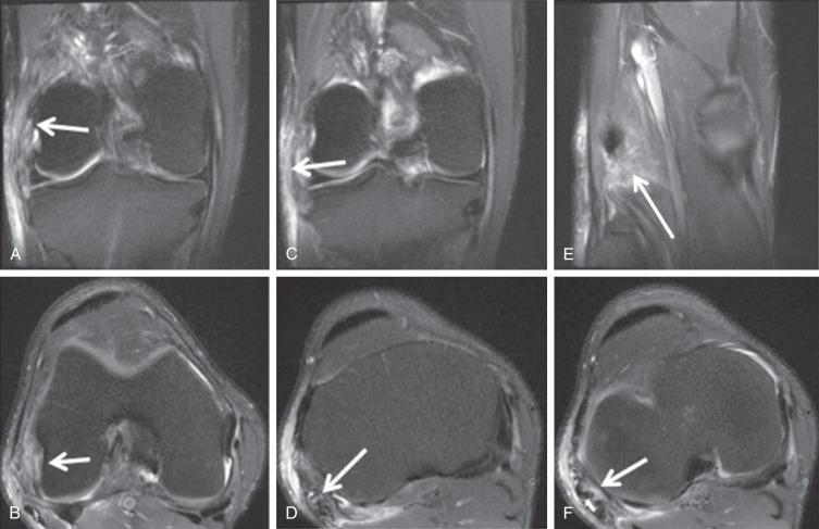 Fig. 91.21, Coronal (A) and axial proton density fat saturation (PD FS) (B) images demonstrate a fibular collateral ligament complete tear (arrows) . Coronal (C) and axial PD FS (D) images demonstrate biceps femoris insertion partial tear (arrows) . Coronal (E) and axial PD FS (F) images demonstrate arcuate ligament tear (arrows) .