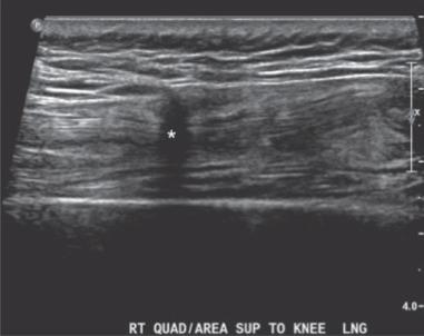 Fig. 91.3, Long-axis grayscale ultrasound image of quadriceps tendon show a focal full or near full thickness tear (asterisk) .