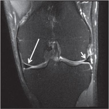 Fig. 91.4, Coronal proton density fat saturation image shows a normal medial meniscus (long arrow) and lateral meniscus (short arrow) .