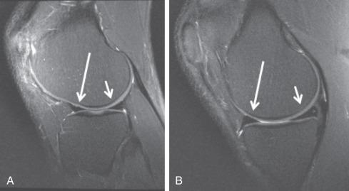 Fig. 91.5, Sagittal proton density fat saturation images in the lateral compartment (A) and medial compartment (B) show normal anterior and posterior horns ( long arrow and short arrows , respectively).