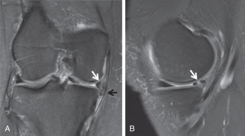 Fig. 91.6, Coronal (A) and sagittal (B) proton density fat saturation images demonstrate a medial meniscal tear (white arrows) . A fragment is flipped into the inferior gutter ( black arrow in A).