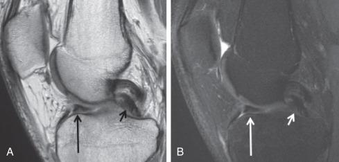 Fig. 91.7, SAG PD (A), PD FS (B) images demonstrate the double delta (long arrows) and double posterolateral corner (short arrows) signs of a bucket handle tear of the medial meniscus.