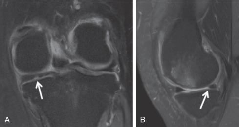 Fig. 91.8, Coronal proton density fat saturation (PD FS) image (A) image demonstrates increased signal in the posterior horn of the medial meniscus (arrow) . Sagittal PD FS MR image (B) demonstrates corresponding blunting of the free edge on lateral view (arrow) . Findings represent partial thickness radial tear.