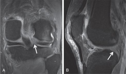 Fig. 91.9, Coronal proton density fat saturation (PD FS) image (A) demonstrates a complete posterior root tear of the lateral meniscus (arrow) . Sagittal PD FS (B) image demonstrates the “ghost meniscus” (arrow) .