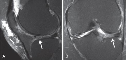 Fig. 91.10, Sagittal (A) and coronal (B) T2 fat saturation images demonstrate an intrameniscal cyst (arrows) in the lateral meniscus. No tear is present.