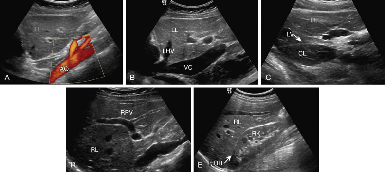 Figure 35-1, A to E, Longitudinal planes of scanning and anatomic landmarks.