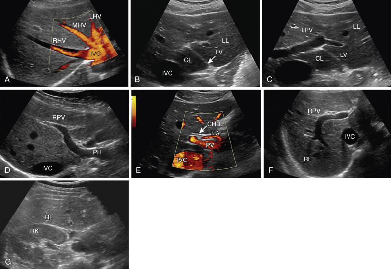 Figure 35-2, A to G, Transverse planes of scanning and anatomic landmarks.