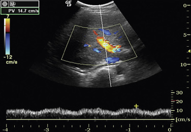 Figure 35-3, Normal portal vein in a healthy 27-year-old woman. Color and duplex Doppler image demonstrates normal hepatopetal portal flow with venous monophasic waveform and minimal respiratory cycling.