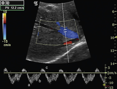 Figure 35-4, Normal middle hepatic vein in a 29-year-old woman. Color and duplex Doppler image demonstrates normal triphasic flow. a, Atrial diastole; b, ventricular systole; c, atrial systole.