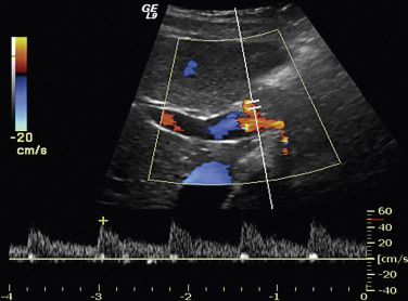 Figure 35-5, Normal hepatic artery in an asymptomatic 30-year-old woman. Color and duplex Doppler image of the porta hepatis shows a normal low-resistance arterial spectral pattern.