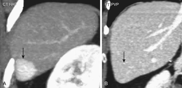 Figure 35-6, Hepatocellular carcinoma (HCC). Coronal reformatted computed tomography images of the liver showing intensely enhancing HCC (arrow) in the arterial phase (A). Note better contrast in the lesion to the parenchyma in this phase in comparison to portal venous phase image (B), in which the lesion is not appreciated (arrow).